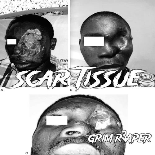 Scar Tissue