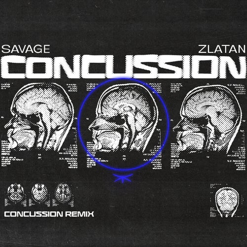 Concussion